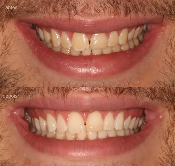 Ofereço serviços de dentista como: limpeza, clareamento, restauração e avaliação
