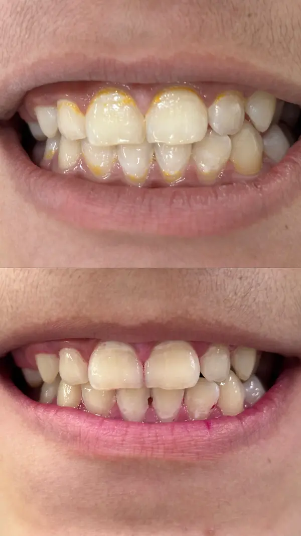 Limpeza odontológica completa